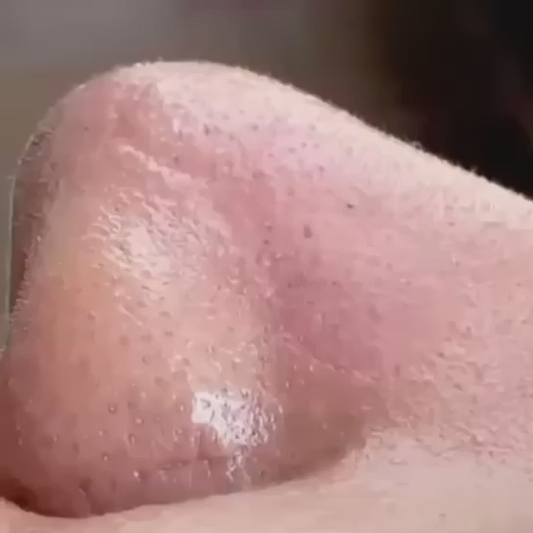 DermaClean Pro - Eliminador de puntos negros y espinillas